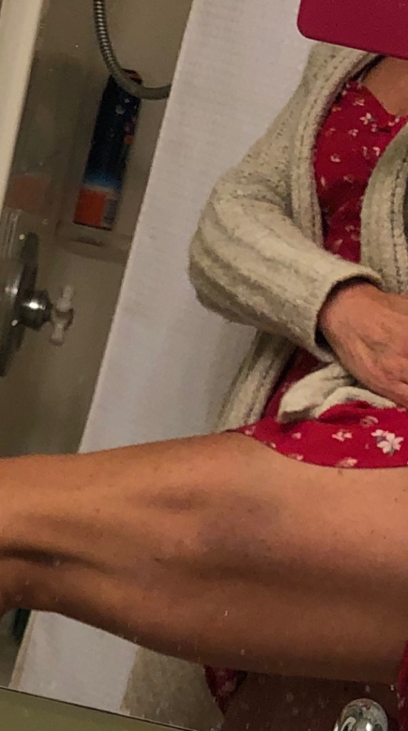 Photo showing a big bruise on my leg! 